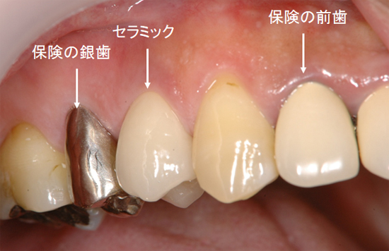 歯 かぶせ もの 値段